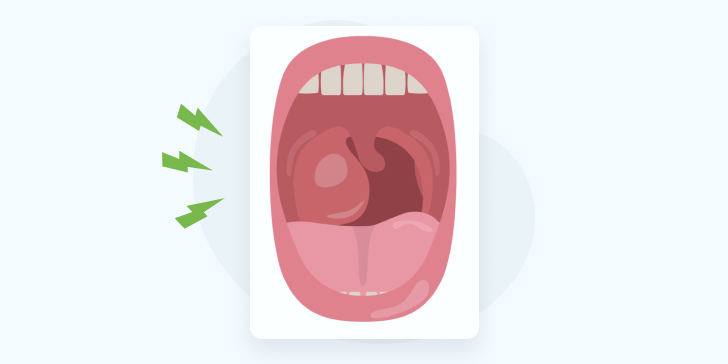 Заглоточный абсцесс