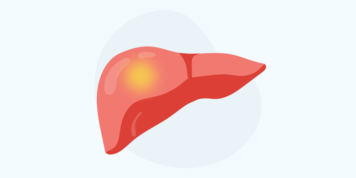 Абсцесс печени