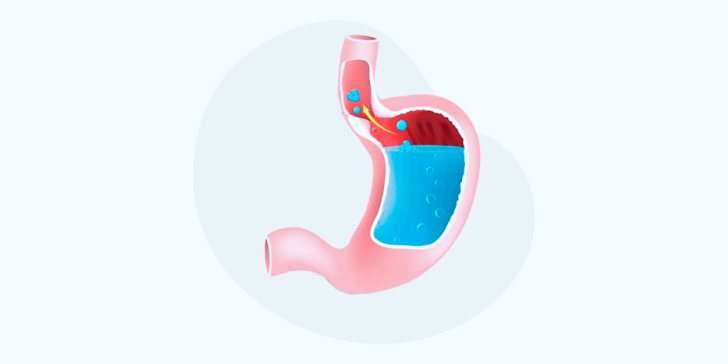 ГЭРБ у детей