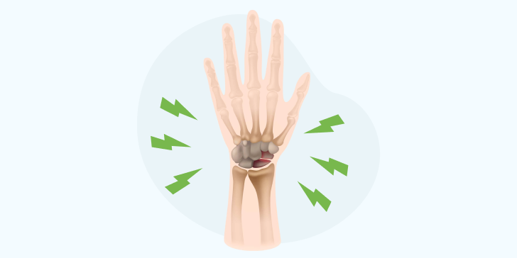 Перелом запястья