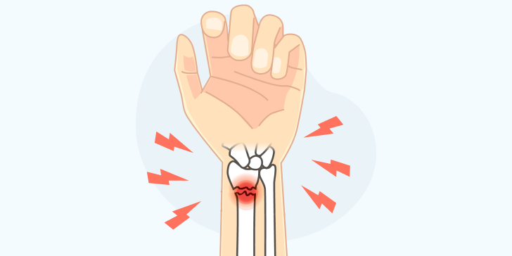 Перелом кисти