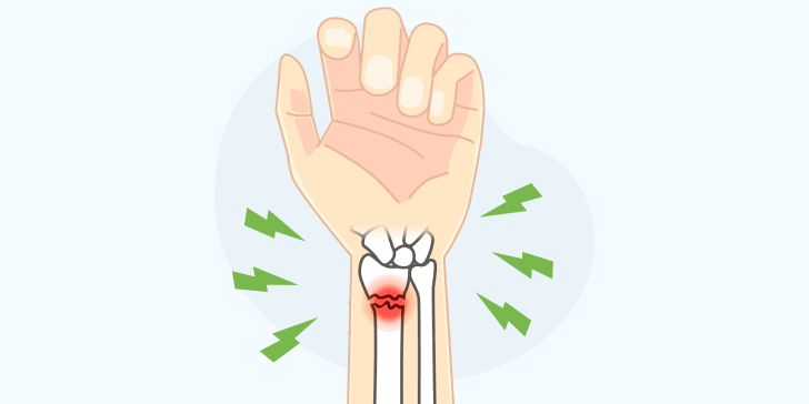 Перелом лучевой кости руки