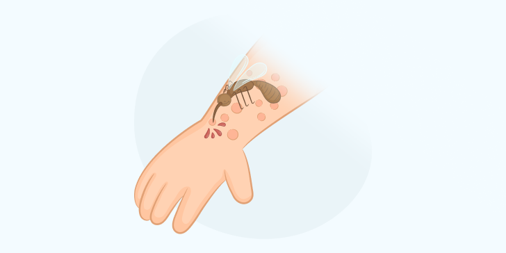 Инсектная аллергия