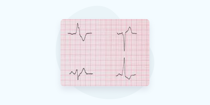 Желудочковая экстрасистолия