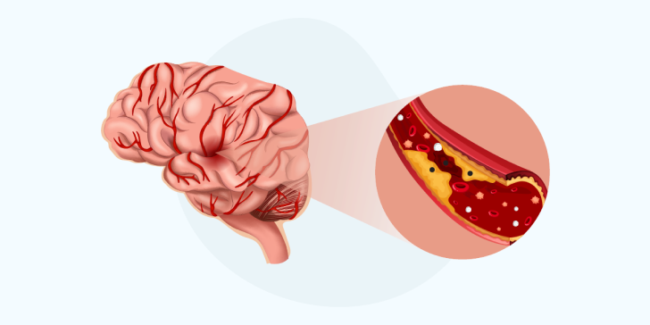 Атеросклероз сосудов головного мозга