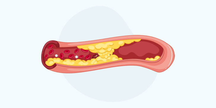 Атеросклероз