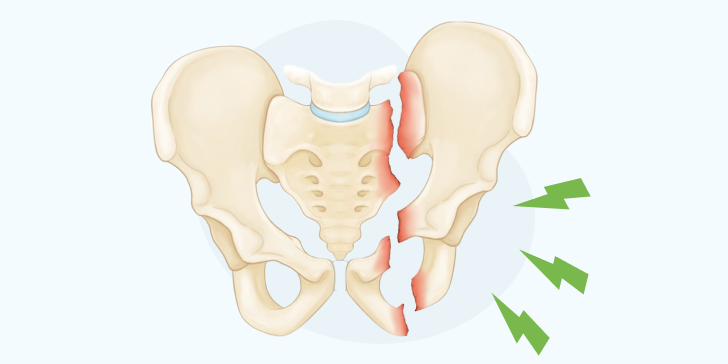 Перелом костей таза