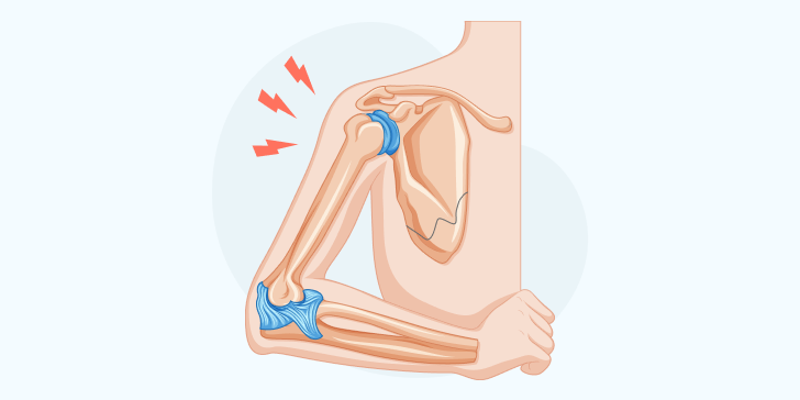 Перелом лопатки