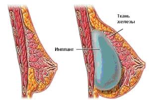 имплант в женской груди (Рисунок 3)