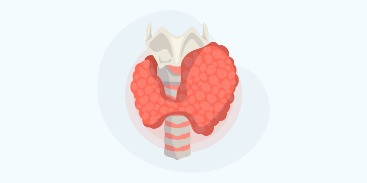 Узловой зоб