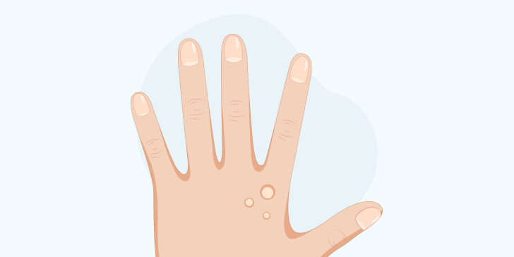 Бородавки у детей