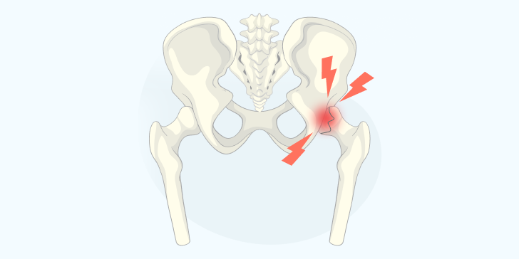 Перелом шейки бедра