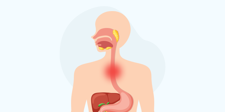 Ожог пищевода