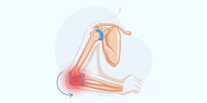 Вывих локтевого сустава