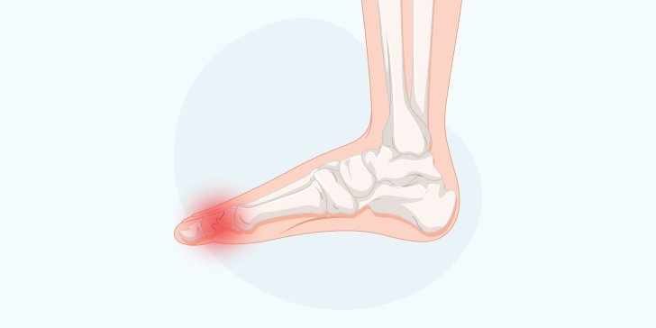 Перелом большого пальца на ноге