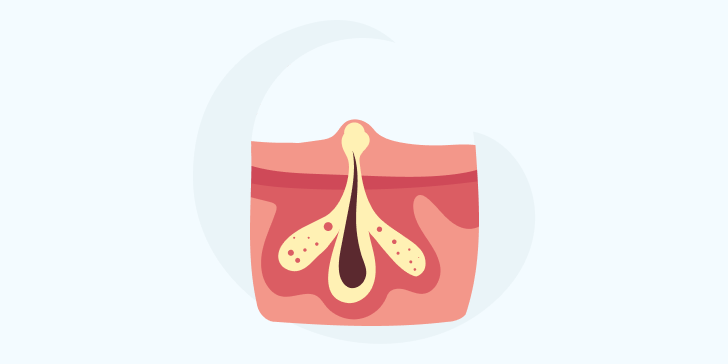 фурункул у ребенка