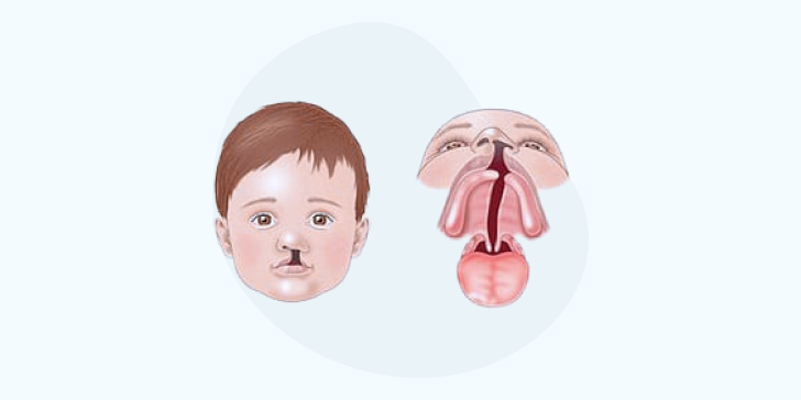 Открытая ринолалия