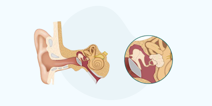 Отосклероз