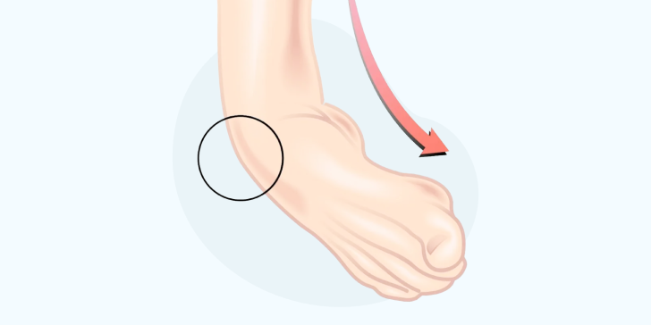 Вывих голеностопного сустава