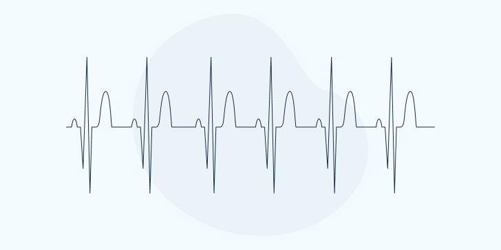 Синусовая тахикардия