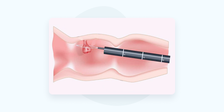 Полипы кишечника