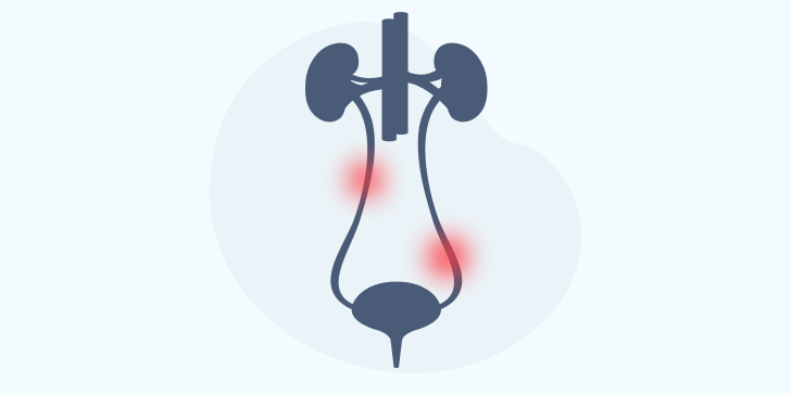 Опухоли мочеточника