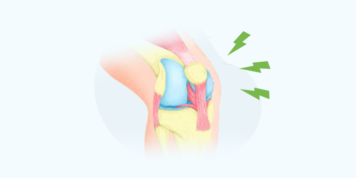 Растяжение связок коленного сустава