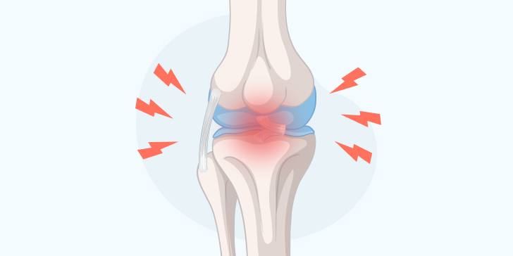 Артроз коленного сустава