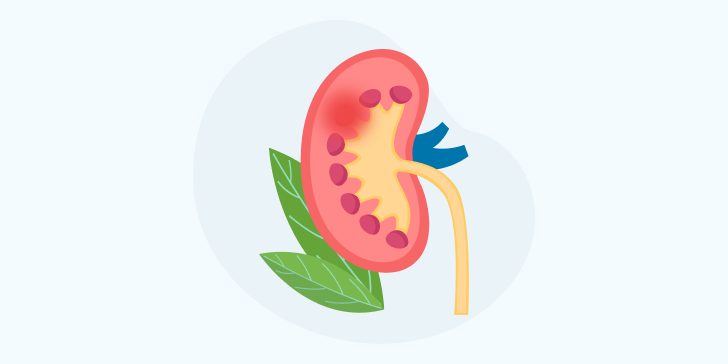 Острый гломерулонефрит