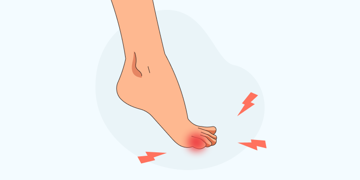 Перелом мизинца на ноге