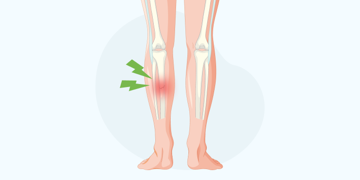Переломы голени