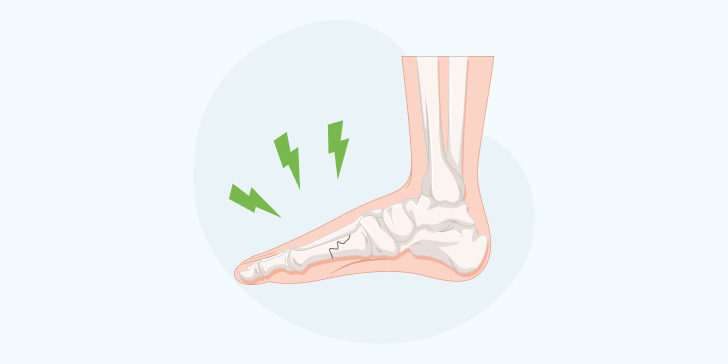Перелом плюсневой кости
