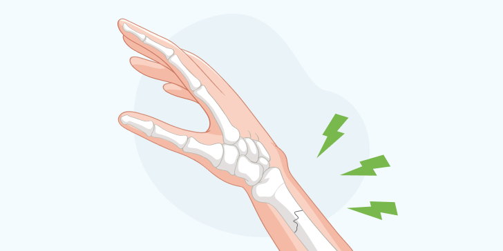 Закрытый перелом руки