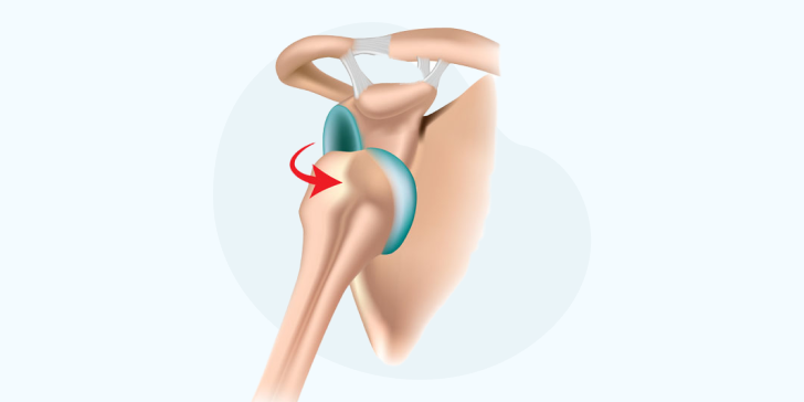 Вывих плечевого сустава
