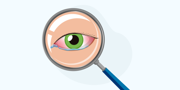 Аллергический конъюнктивит у детей