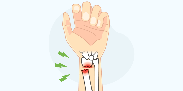 Перелом руки со смещением