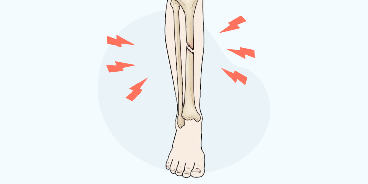 Перелом большеберцовой кости