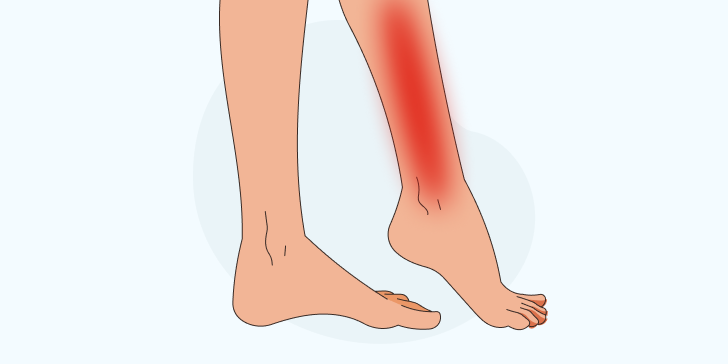 Рожа (рожистое воспаление)