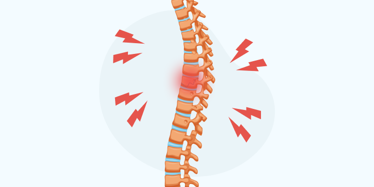 Компрессионный перелом позвоночника