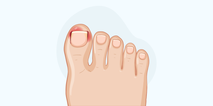 Удаление вросшего ногтя