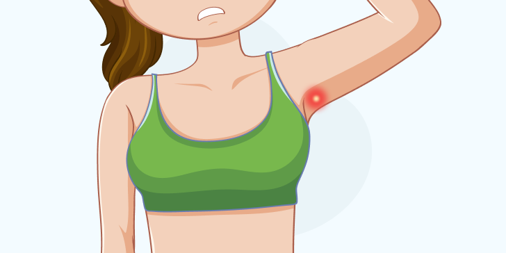 Гидраденит