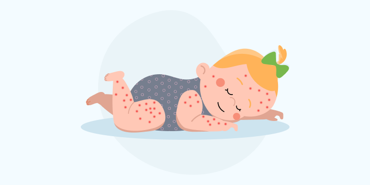 Тромбоцитопения у детей