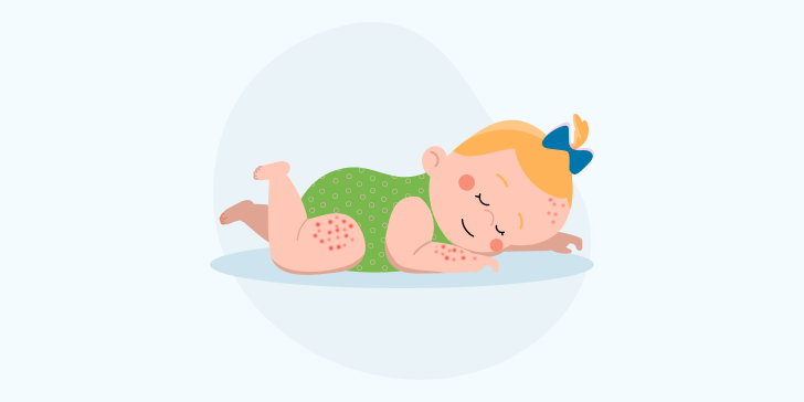 Контактный дерматит у ребенка