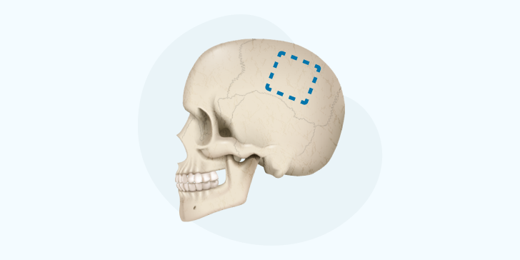 Трепанация черепа