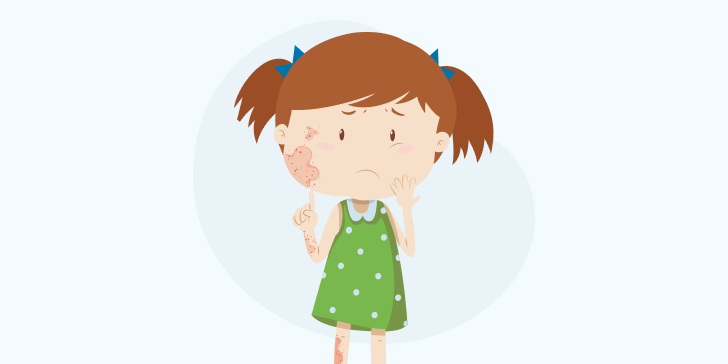 Стригущий лишай у детей