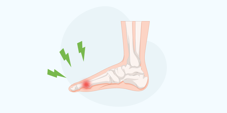 Острый остеомиелит