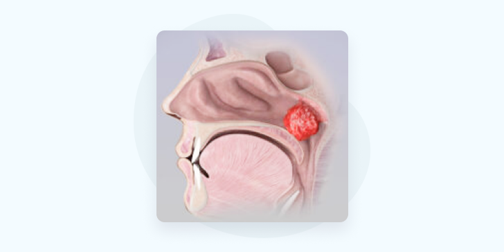 Киста Торнвальда
